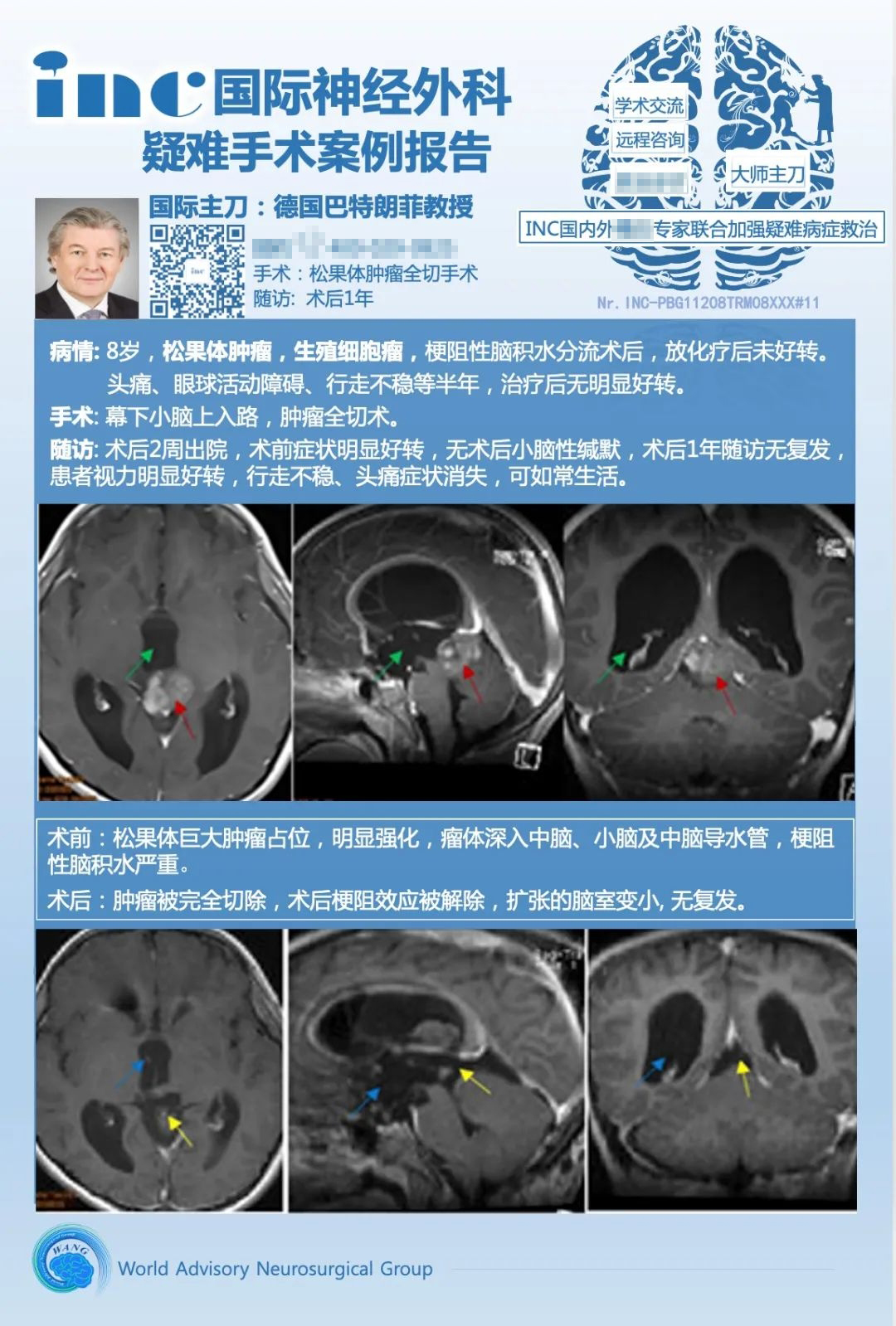 松果體生殖細(xì)胞瘤