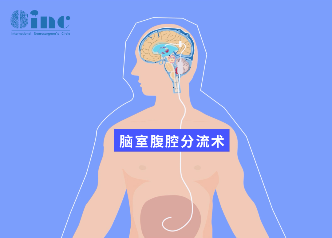兒童腦積水腦室－腹腔分流術(shù)后，可能出現(xiàn)哪些問題？