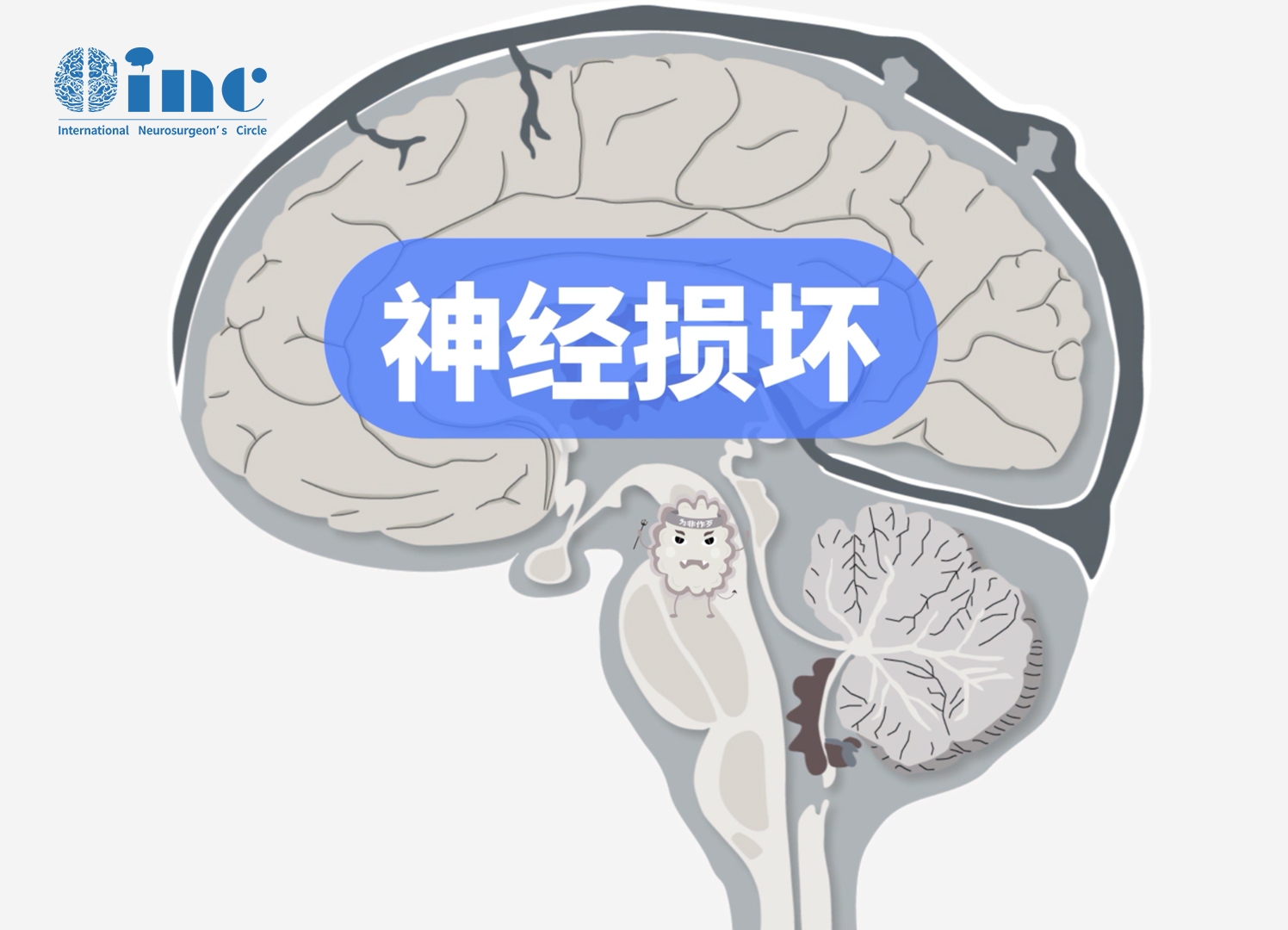 腦干<a href='/jiaozhiliu/' target='_blank'><u>膠質瘤</u></a>手術