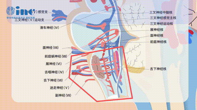 腦干海綿狀血管瘤反復(fù)出血