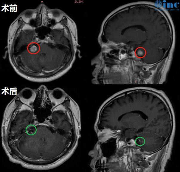 半年突聾兩次、聽(tīng)神經(jīng)瘤侵入內(nèi)聽(tīng)道