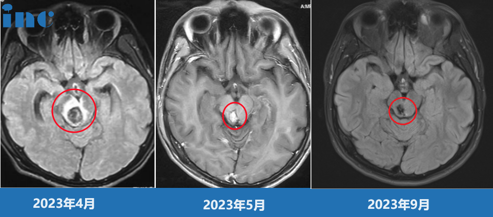 腦干-中腦血管畸形
