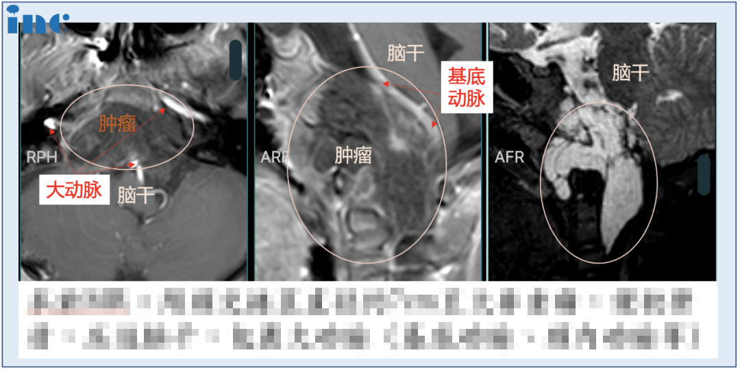 顱底脊索瘤,福洛里希,INC