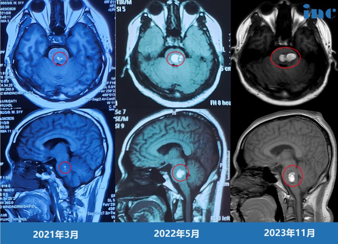 33歲男性-腦干（橋腦）海綿狀血管瘤3次出血