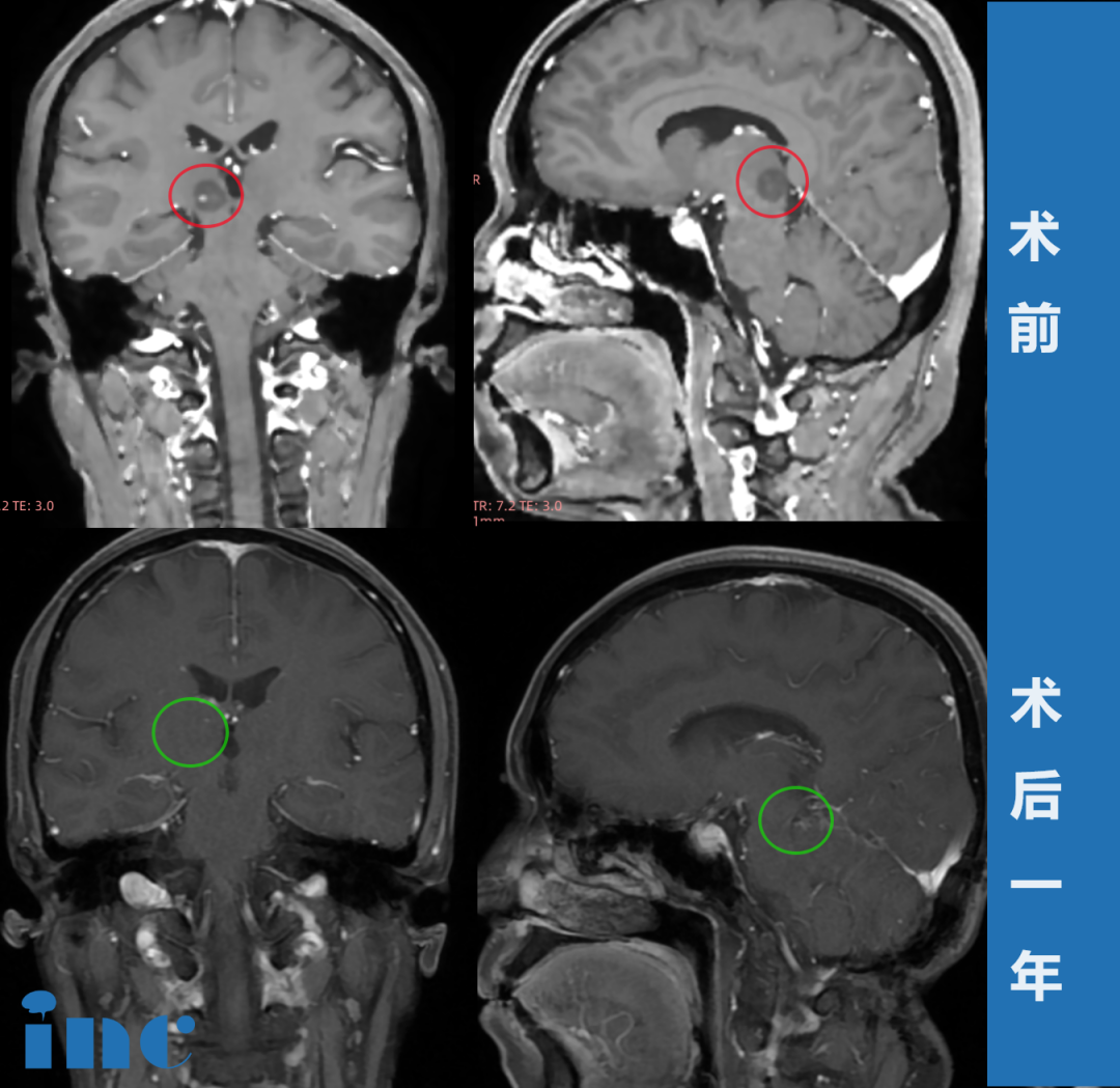 高難度丘腦膠質(zhì)瘤術(shù)后患者自述——影像