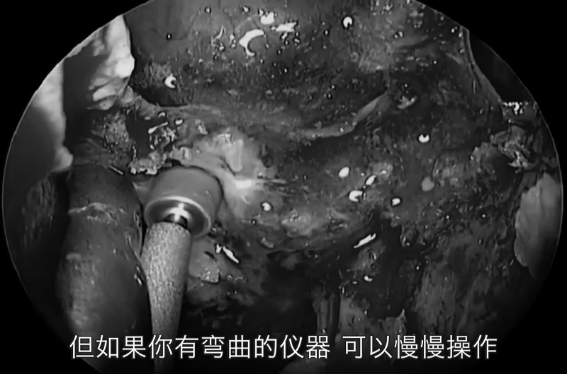 如果你有彎曲的儀器可以慢慢操作，因?yàn)榧顾髁鍪擒浀模@也是脊索瘤的特點(diǎn)之一