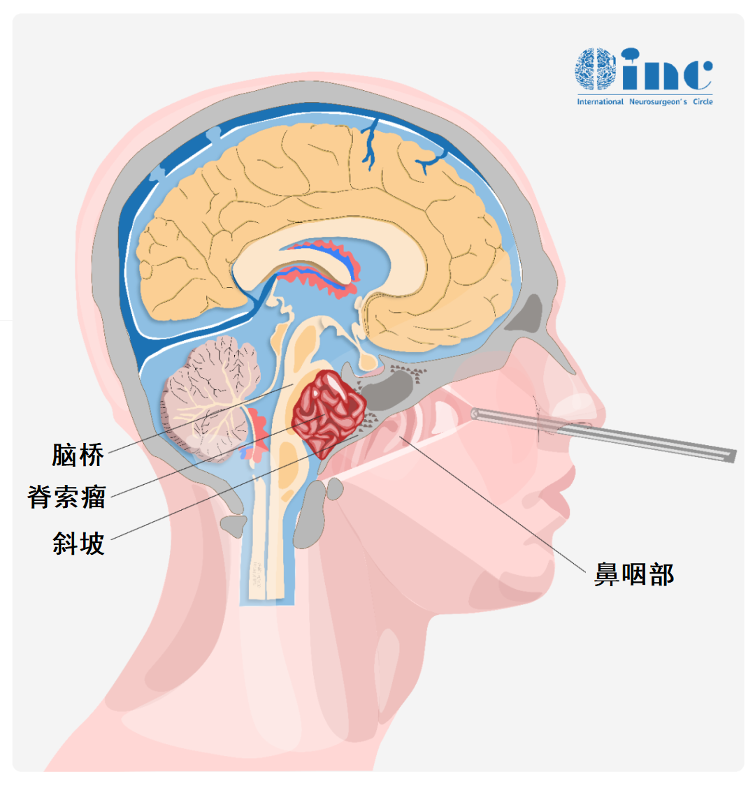 不開顱從鼻孔1cm切口竟就可以取出較大腦瘤，他是怎么做到的？
