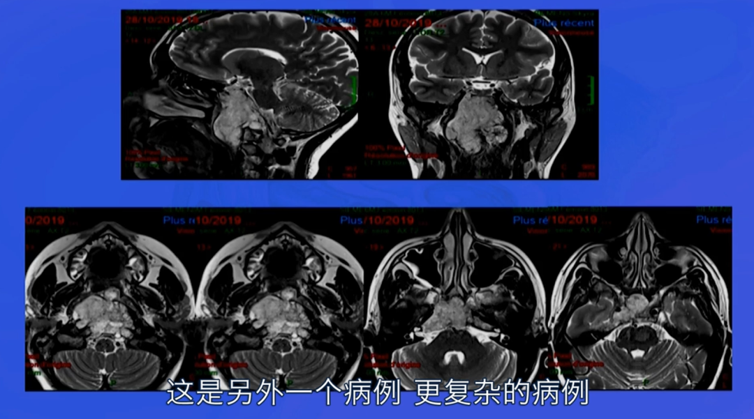 不開顱就把大手術(shù)做了，從鼻子切腦子里的腫瘤