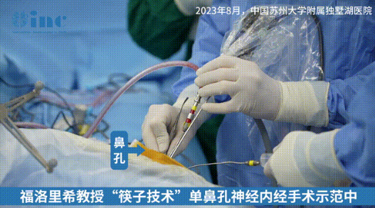 “鼻孔內(nèi)動(dòng)刀”不開顱就取出較大腦瘤！單鼻孔神經(jīng)內(nèi)鏡手術(shù)-INC國(guó)際福教授案例