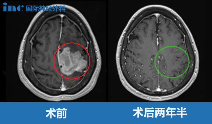 大腦鐮旁較大腦膜瘤——影像