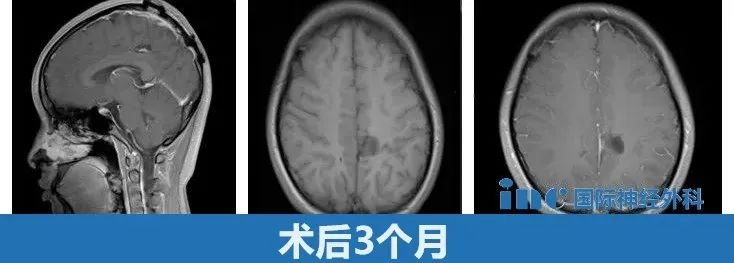 術(shù)后3個月隨訪
