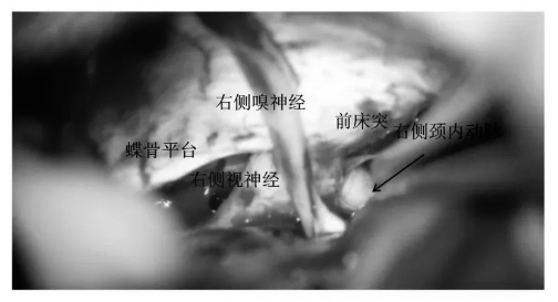 充分游離后可見視神經(jīng)、嗅神經(jīng)、頸內(nèi)動脈、前床突等結(jié)構(gòu)