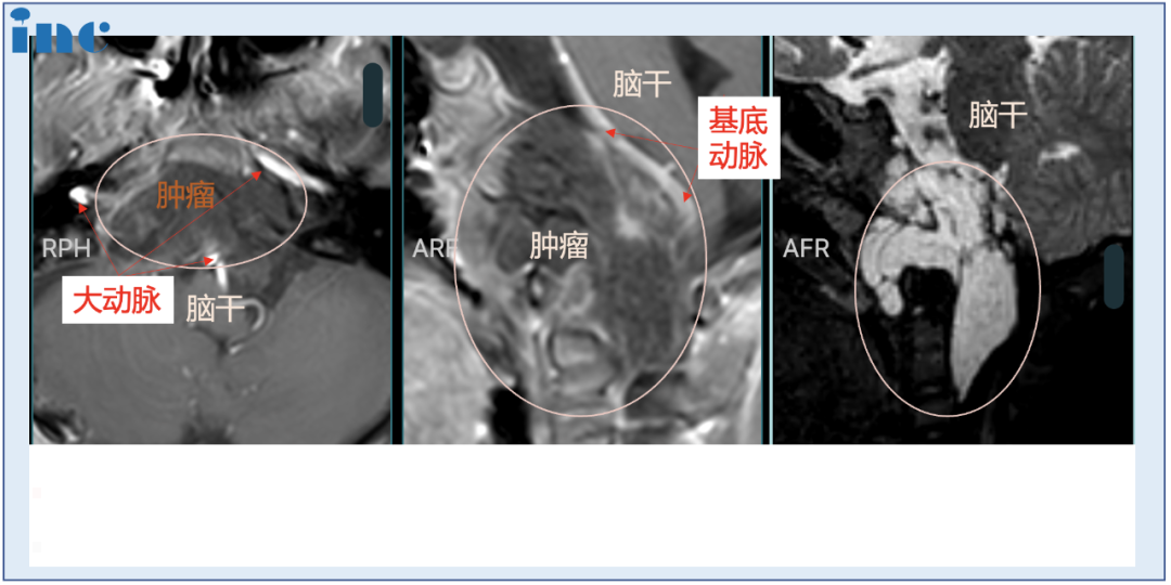 6歲男孩較大脊索瘤，單鼻孔8mm切口，不開顱成功手術(shù)