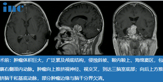 48歲較大脊索瘤復發(fā)患者，“雙鏡聯(lián)合”中國示范手術(shù)