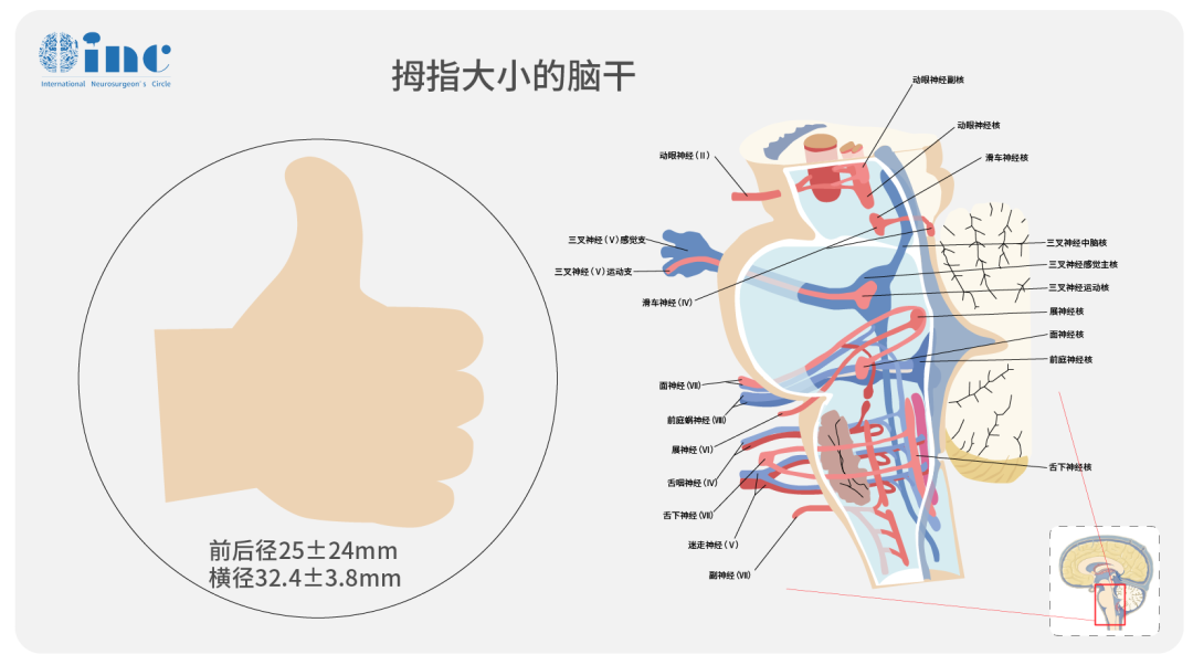 腦干海綿狀血管瘤手術