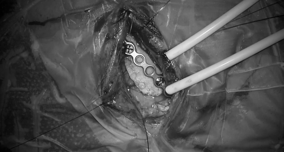 使用腹部脂肪進(jìn)行術(shù)野填充（避免使用人工耗材-具有炎性等風(fēng)險(xiǎn)，可致眼部不適影響生活質(zhì)量）
