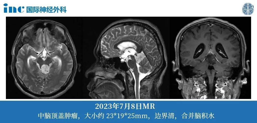 36歲男性--四疊體區(qū)占位；梗阻性腦積水