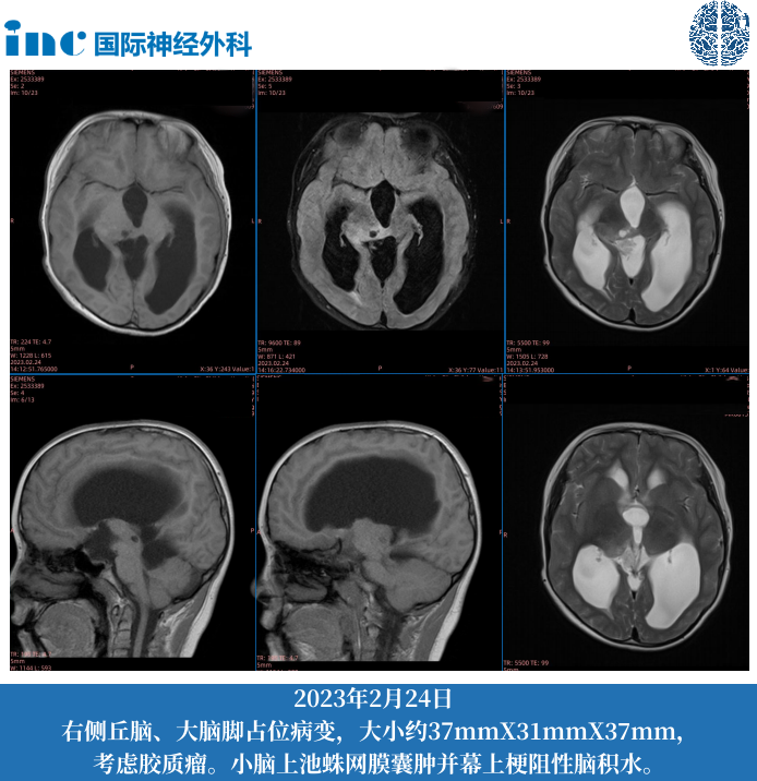 11歲男孩--中腦-丘腦占位；梗阻性腦積水（側(cè)腦室腹腔分流術(shù)后）
