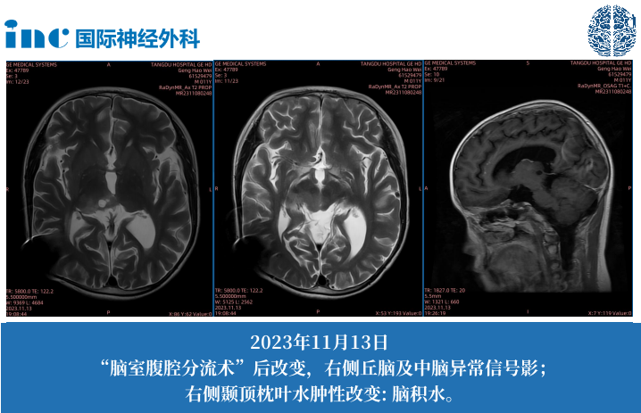 11歲男孩--中腦-丘腦占位；梗阻性腦積水（側(cè)腦室腹腔分流術(shù)后）