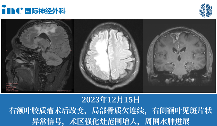 額葉膠質(zhì)母細(xì)胞瘤術(shù)后癥狀加重偏癱