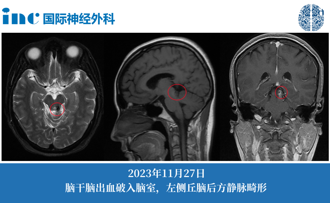 靜脈畸形伴出血