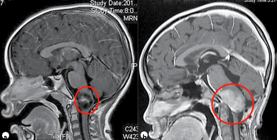 一名7歲兒童浸潤性頸髓腫瘤的矢狀面造影后t1加權(quán)MRI(a)