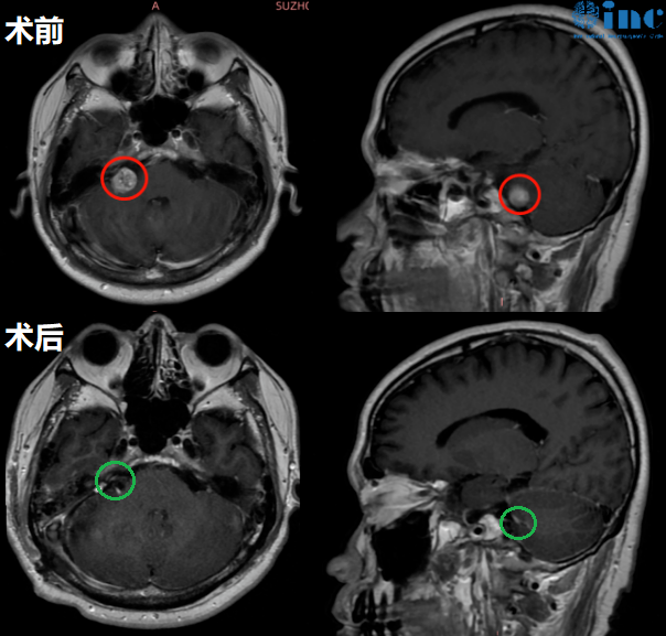 聽(tīng)神經(jīng)瘤真實(shí)案例