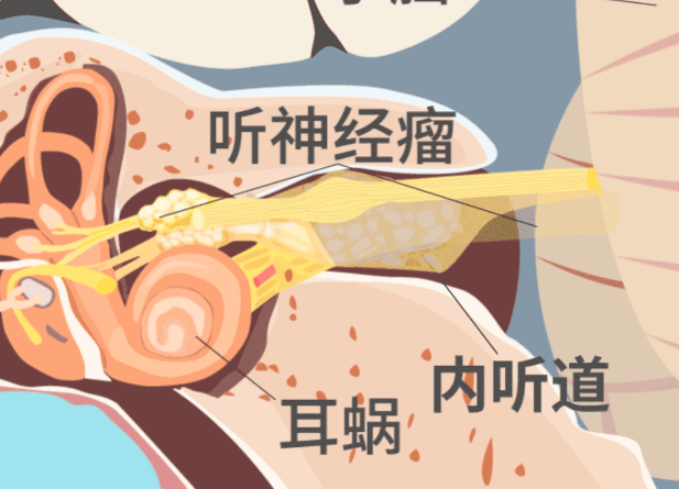突發(fā)耳聾耳鳴也要警惕聽(tīng)神經(jīng)瘤