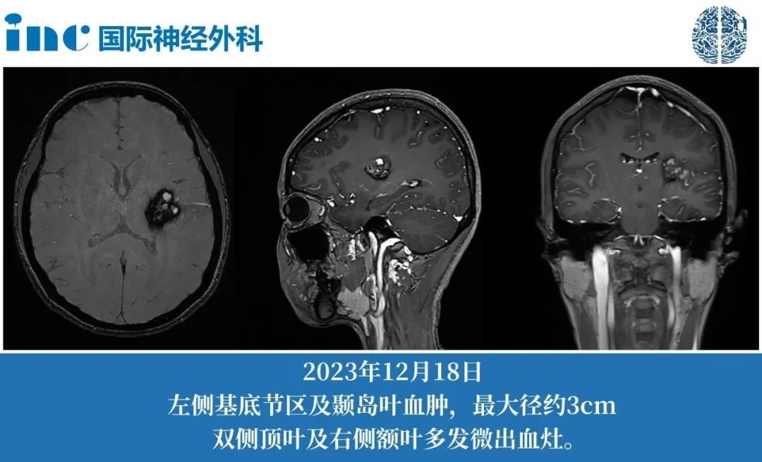 26歲女性基底節(jié)海綿狀血管瘤2次出血，癥狀加重，這次該如何應(yīng)對？