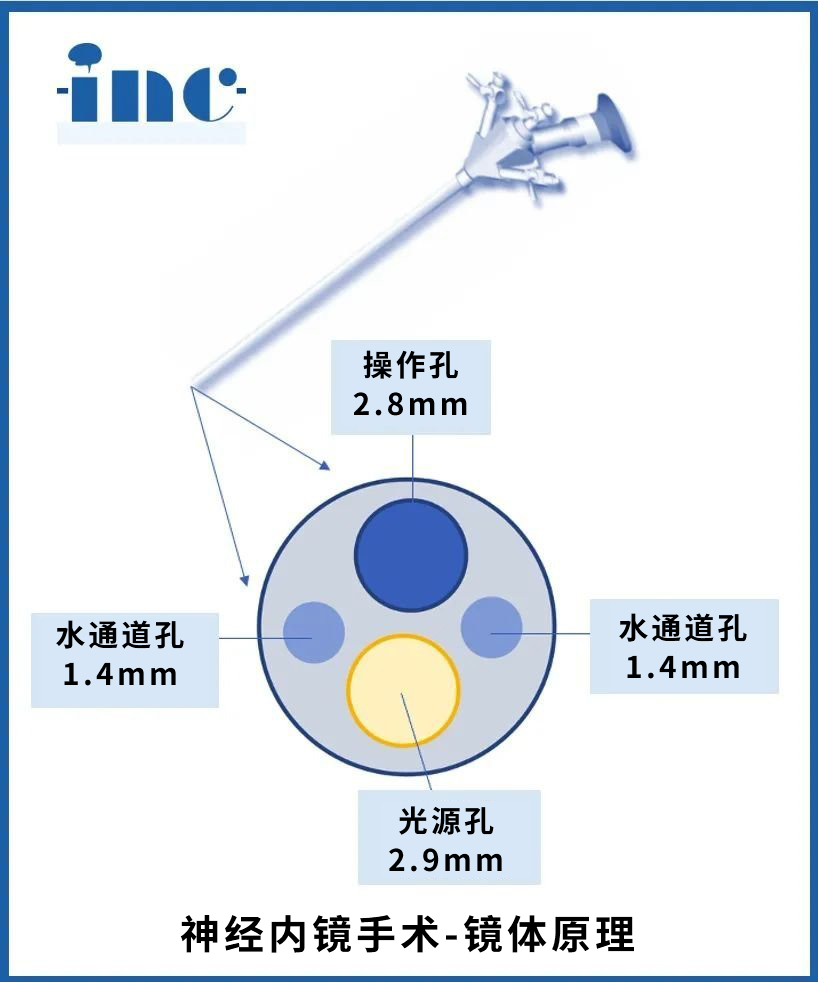 神經(jīng)內(nèi)鏡