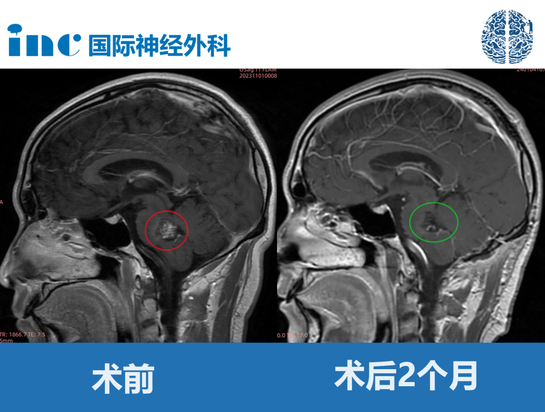 30歲男性-腦干海綿狀血管瘤，可以順利全切、無并發(fā)癥嗎？