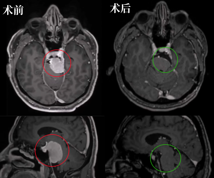 54歲男性-較大巖斜區(qū)腦膜瘤，壓迫腦干痛不欲生，還能順利全切嗎？