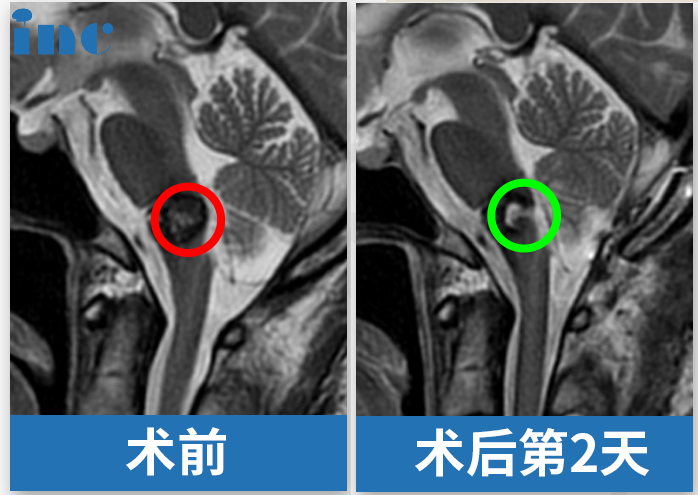 手術(shù)結(jié)果：顯微鏡下全切腫瘤，手術(shù)順利。術(shù)后無(wú)任何新發(fā)神經(jīng)損傷