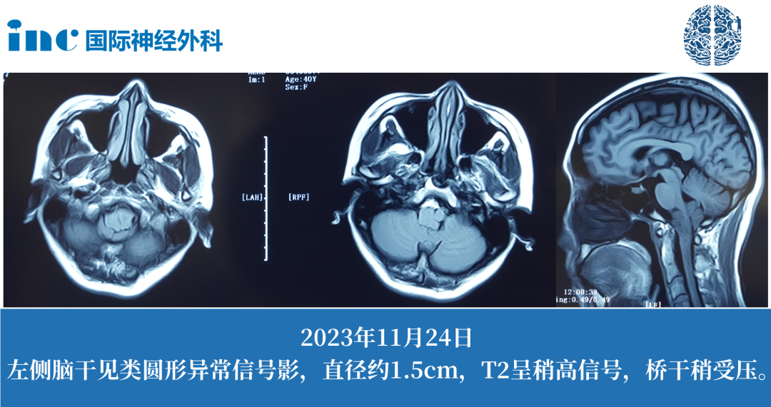 40歲女性--延髓占位性病變