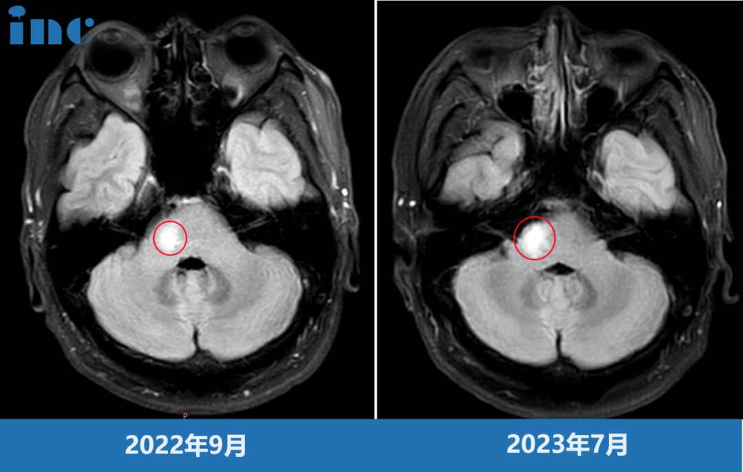 33歲男性--腦干橋臂膠質(zhì)瘤