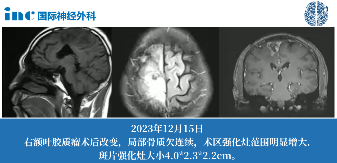46歲--膠質(zhì)母細胞瘤4級