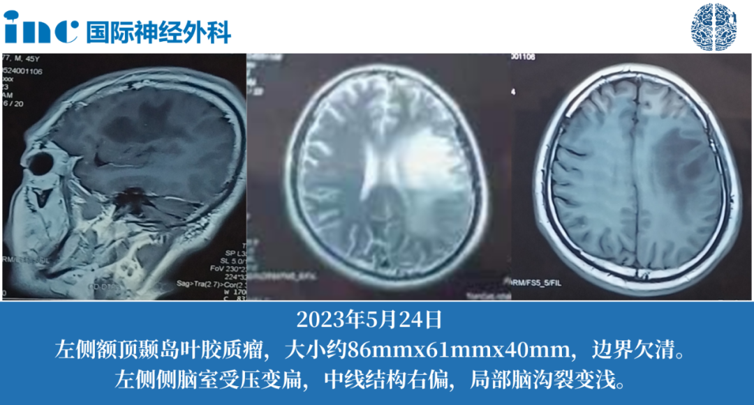 48歲男性--左側(cè)額頂顳島葉膠質(zhì)瘤