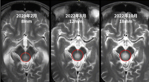 21歲男性--中腦頂蓋膠質(zhì)瘤