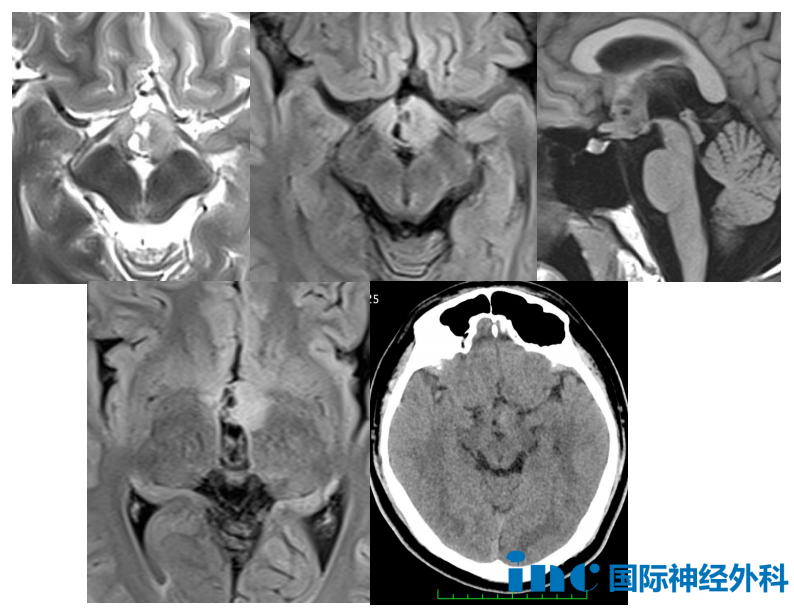 15歲男孩--視神經(jīng)膠質(zhì)瘤