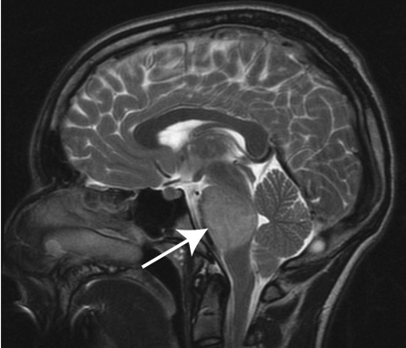 圖1:T2加權(quán)矢狀面(DIPG)兒童腦部MRI