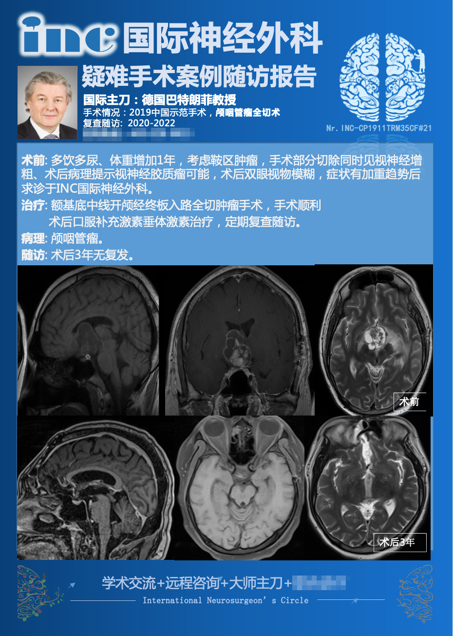 30多歲男性顱咽管瘤全切術(shù)后3年沒有復(fù)發(fā)