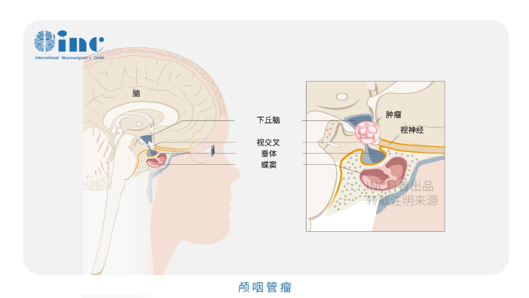 顱咽管瘤的手術(shù)成功率高不高？風(fēng)險(xiǎn)大嗎？