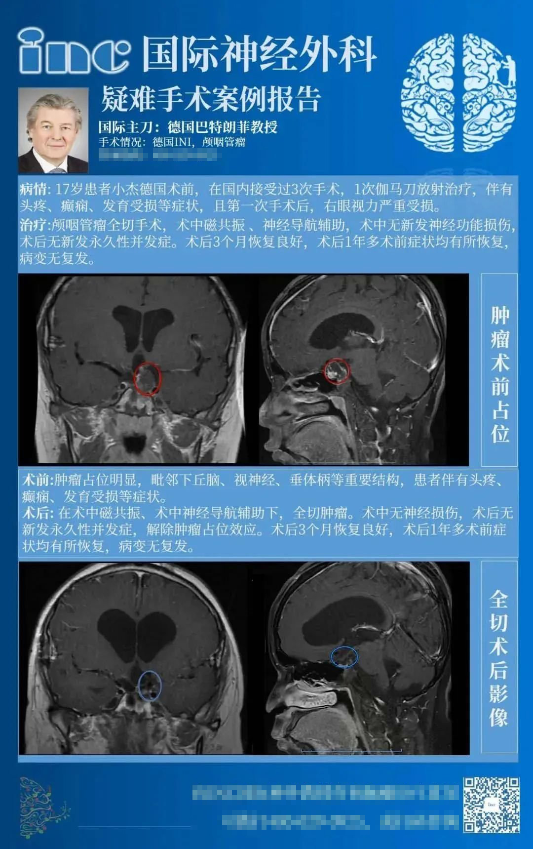18歲男孩顱咽管瘤16年3次復(fù)發(fā)，癲癇、發(fā)育遲滯