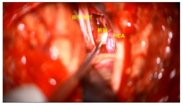 暴露橋腦，側(cè)方橋腦偏飽滿
