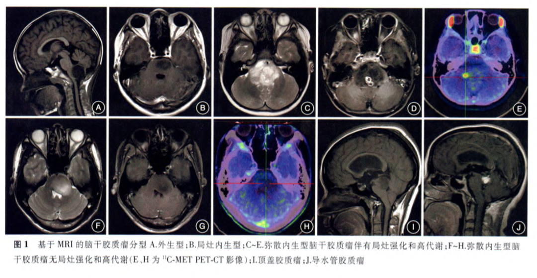 圖1.基于MRI的腦干膠質(zhì)瘤分型A.外生型；B.局灶內(nèi)生型；C-E.彌散內(nèi)生型腦干膠質(zhì)瘤伴有局灶強(qiáng)化和高代謝；F-H.彌散內(nèi)生型腦干膠質(zhì)瘤無局灶強(qiáng)化和高代謝（C、H為11C-METPET-CT影像）；I.頂蓋膠質(zhì)瘤；J.導(dǎo)水管膠質(zhì)瘤.不同型治療或預(yù)后會(huì)有差別。圖自腦干膠質(zhì)瘤咨詢共識(shí)