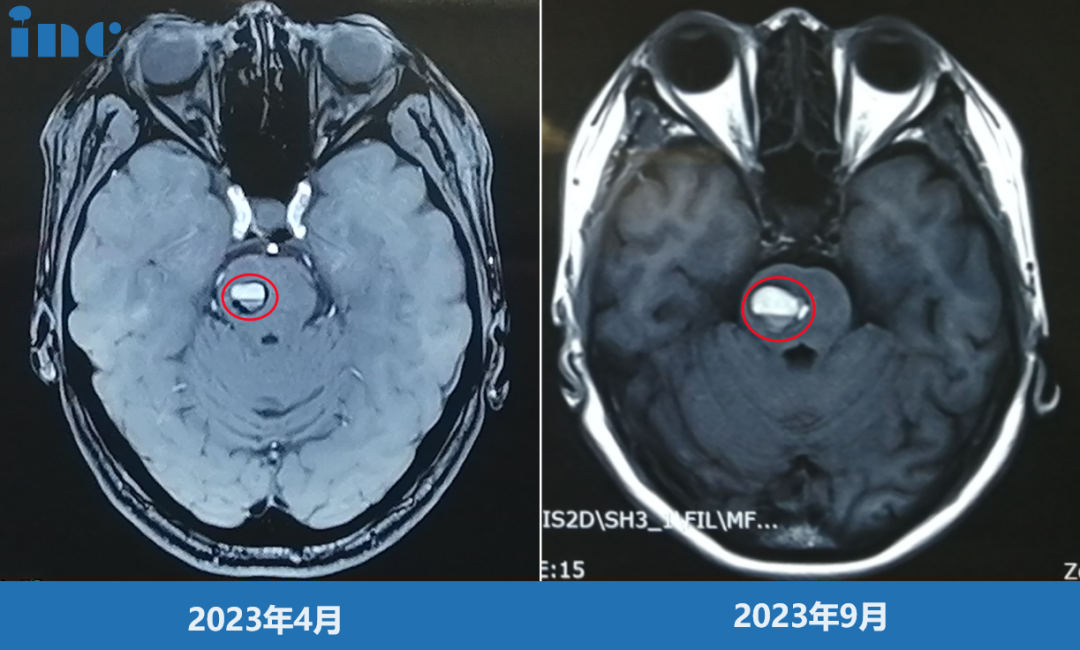 影像對比提示金女士的海綿狀血管瘤增大，出血量逐漸增多