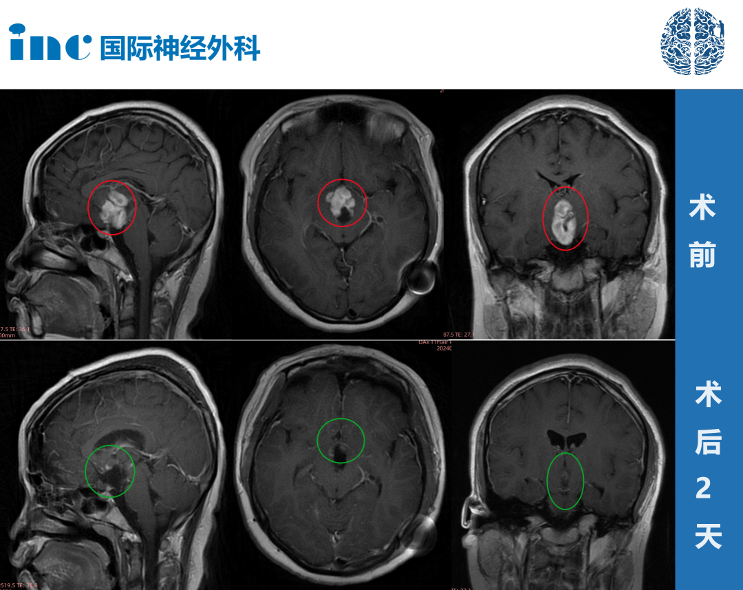 視神經(jīng)-下丘腦區(qū)較大膠質(zhì)瘤案例
