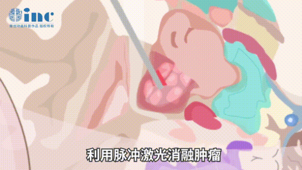手術(shù)僅需在患處頭皮上切約2-4mm寬的小口插入激光光纖探頭至病灶所在位置利用脈沖激光消融腫瘤及病變組織。