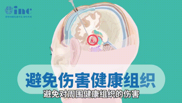 準(zhǔn)確定位病灶
