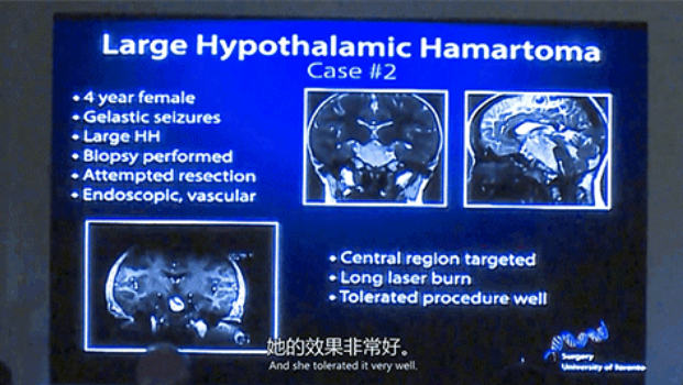 四歲女童深受癡笑樣癲癇困擾  　　LITT技術(shù)消融元兇下丘腦錯(cuò)構(gòu)瘤